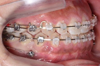 부산치아교정치과