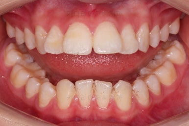 연산동치아교정