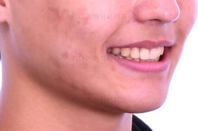 부산연산동치아교정