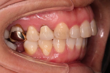 연산동부분교정