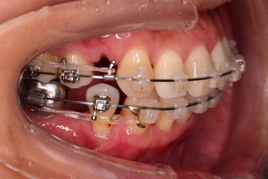 동래임플란트교정