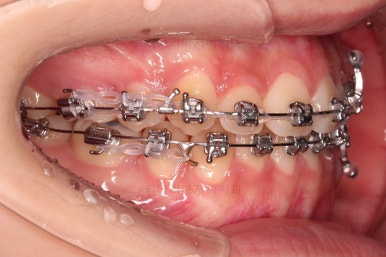 동래구치아교정