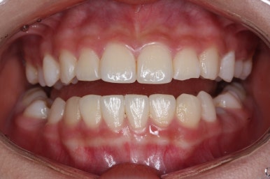 부산치아교정잘하는곳