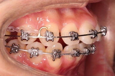 부산치아교정치과