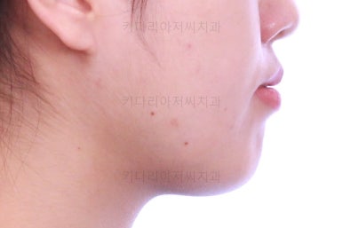 부산비발치교정