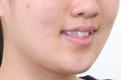 부산비발치교정