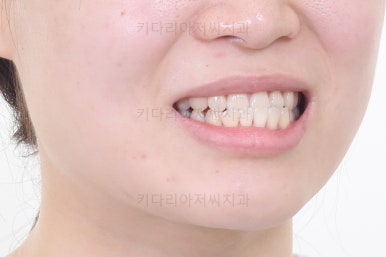 부산치아교정추천