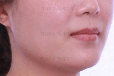 부산치아교정비용