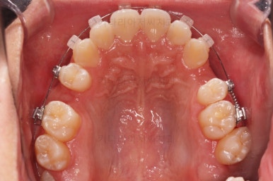 부산청소년치아교정