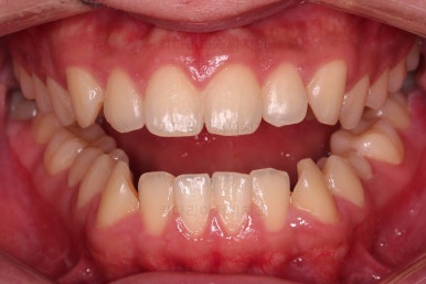 부산주걱턱교정