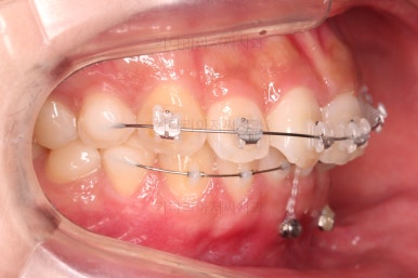 부산앞니부분교정