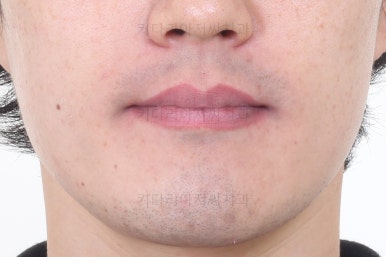 부산비수술교정