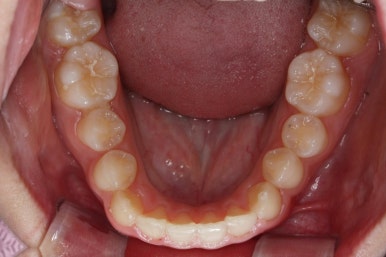 부산비발치교정