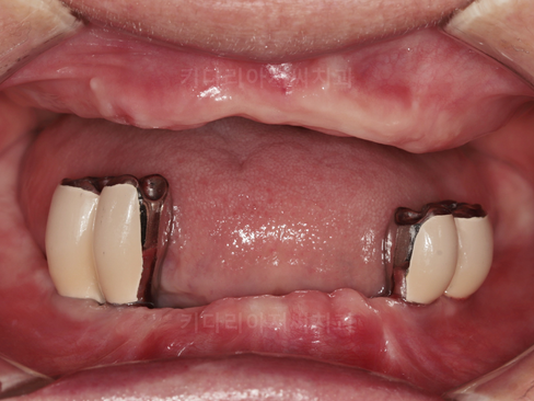 부산보험임플란트