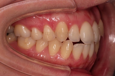 부산치아교정잘하는곳