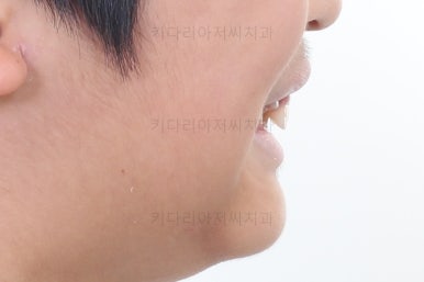 부산어린이돌출입교정