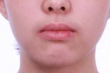 부산투명교정