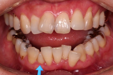 동래임플란트교정