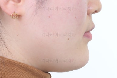 부산치아교정