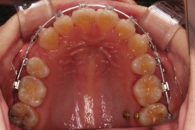 부산연산동교정치과