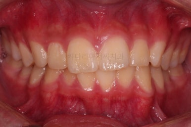 부산연산동사랑니발치