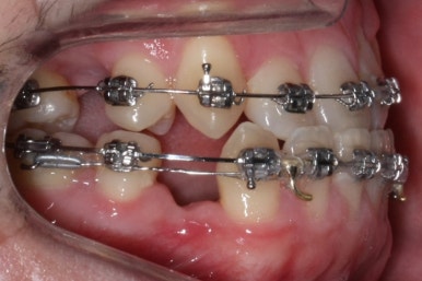 부산구순구개열