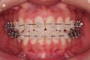 부산교정잘하는치과