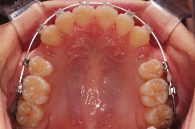 부산돌출입교정