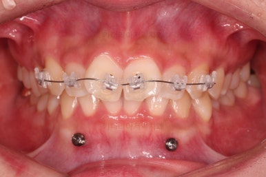 부산앞니부분교정