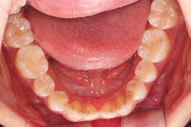 연산동치아교정