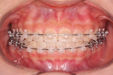 부산치아교정잘하는곳