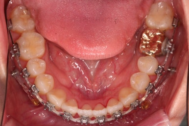 부산치아교정잘하는곳