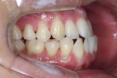 부산비수술교정