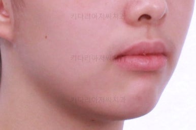 부산투명교정
