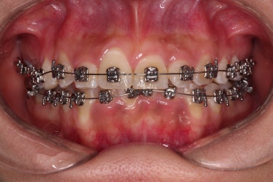 부산안면비대칭