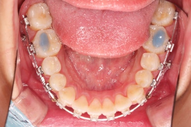 부산연산역치아교정