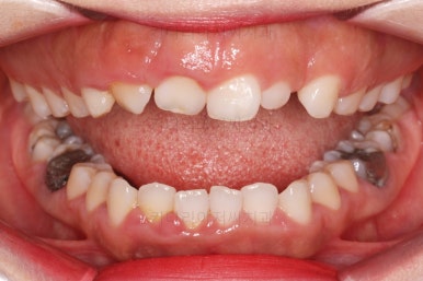 부산구순구개열