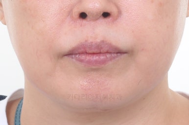 동래임플란트교정