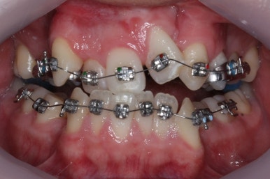 부산구순구개열