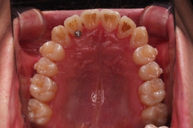 부산인비절라인