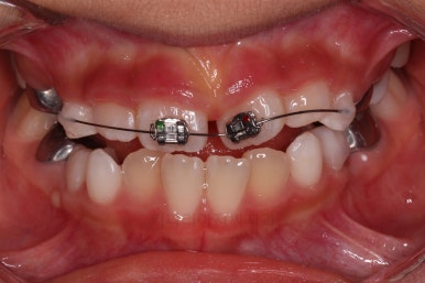 부산어린이반대교합