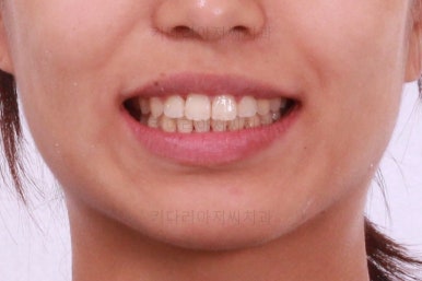 부산연산역치아교정