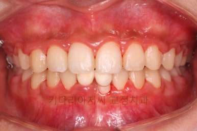 연산동치아교정