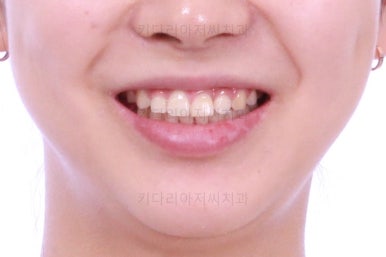 부산안면비대칭