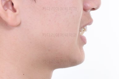 부산청소년치아교정