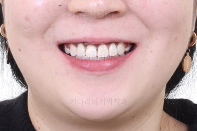 부산세라믹교정