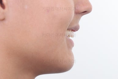 부산연산동치아교정