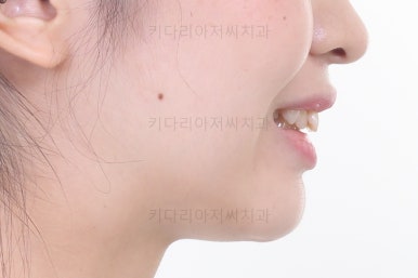 부산돌출입교정