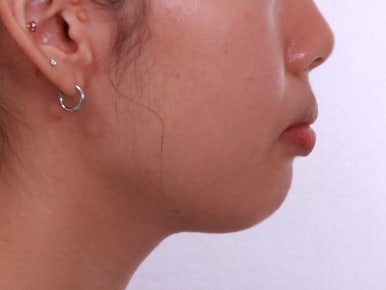 부산덧니교정