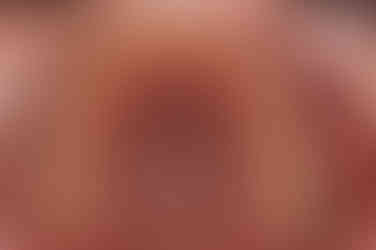 부산비발치교정